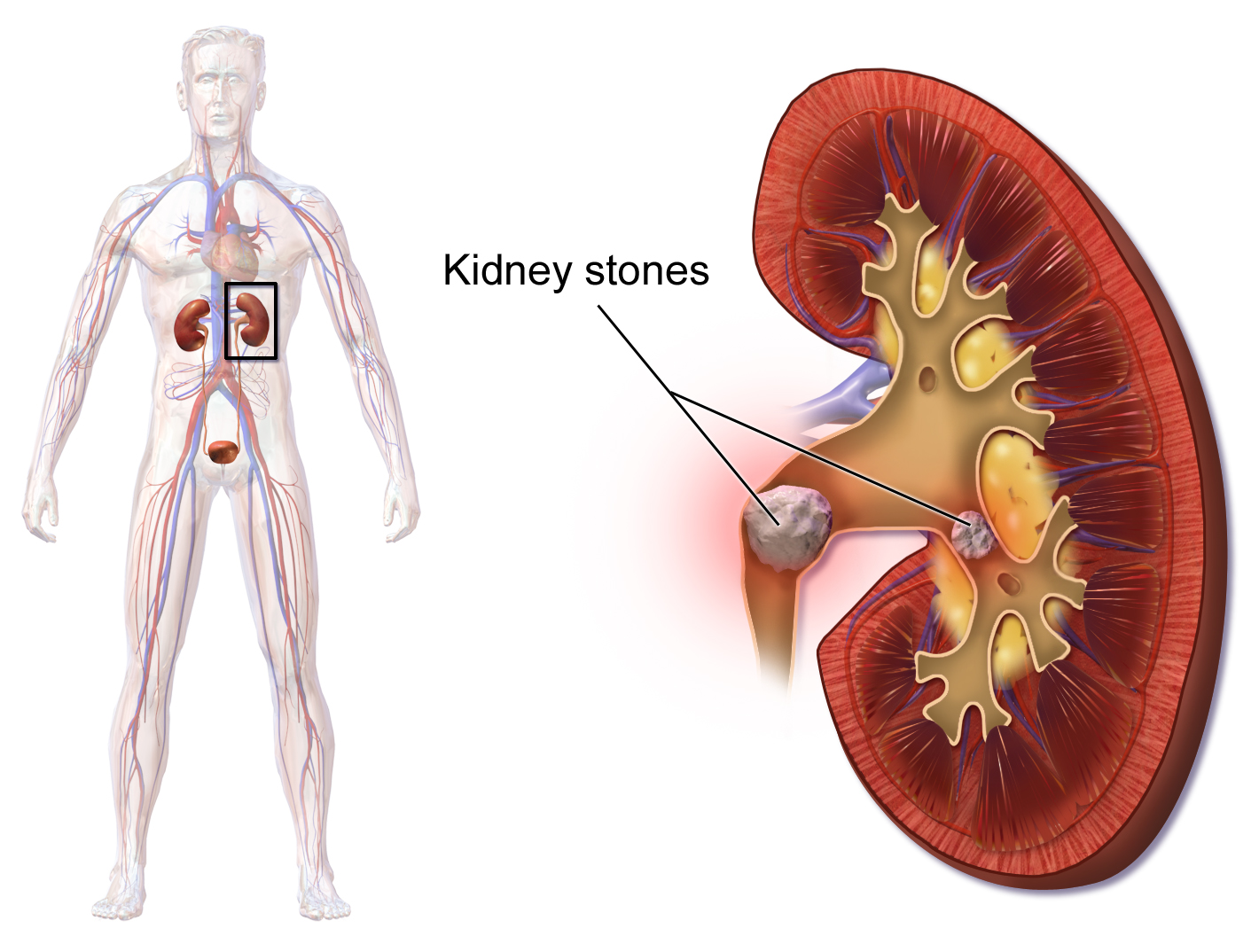 kidney stones || Will the mixture of cabbage and tomato lead to formation of kidney stones
