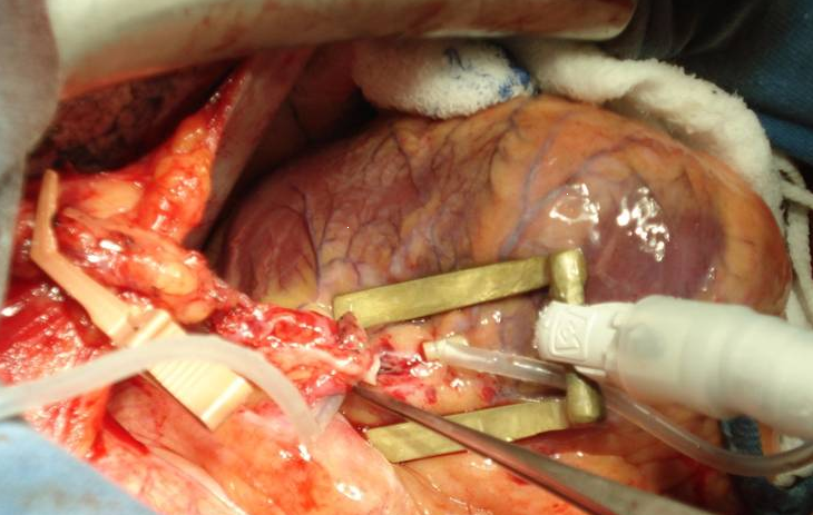 coronary artery bypass graft || coronary artery bypass graft