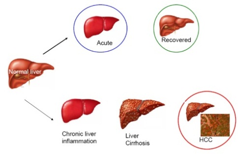 Liver failure or cirrhosis || Liver failure or cirrhosis