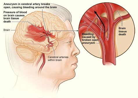 brain haemorrhage
