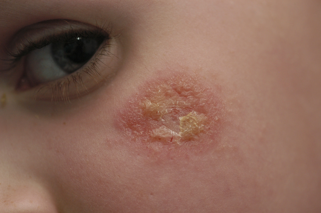 Symptoms of eczema || Symptoms of eczema