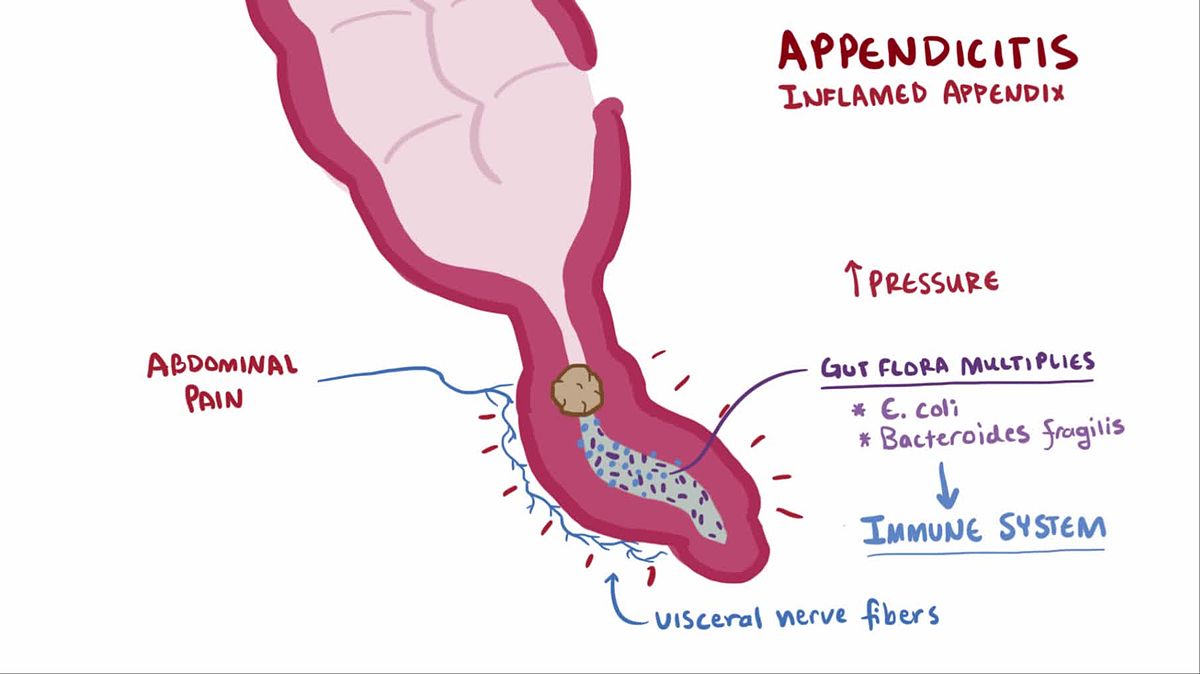 Appendicitis : Symptoms,Causes,Diagnosis,Treatment