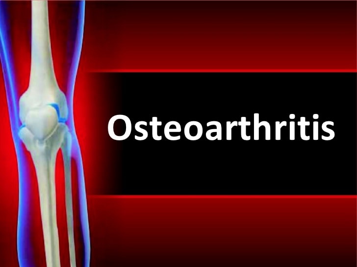  osteoarthritis