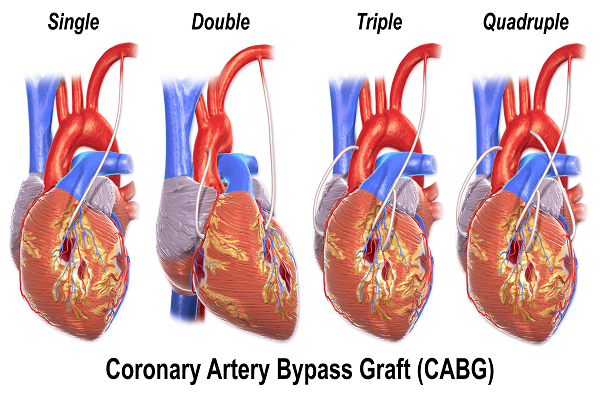 Coronary artery bypass grafting (CABG)