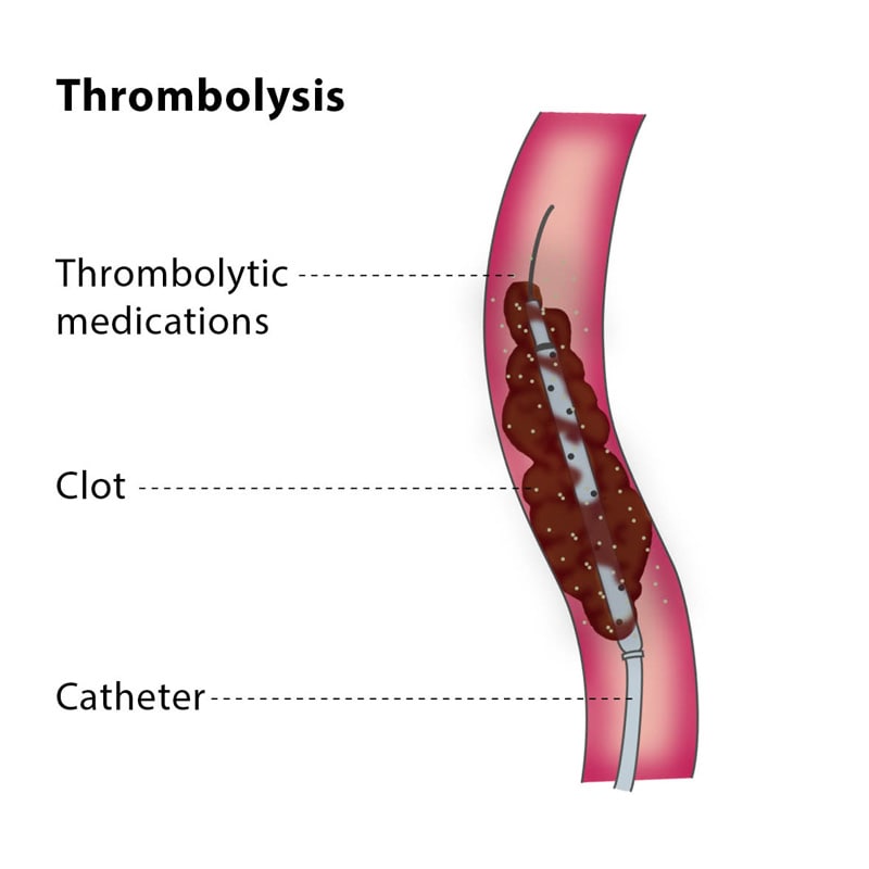 thrombolys