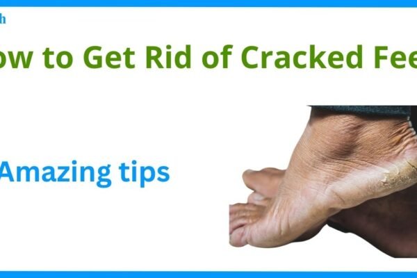 How to Get Rid of Cracked Feet