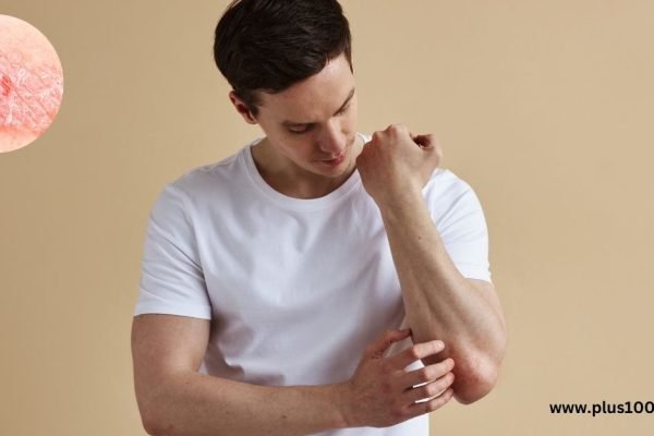 What is Psoriasis Know the perfect natural remedies for psoriasis
