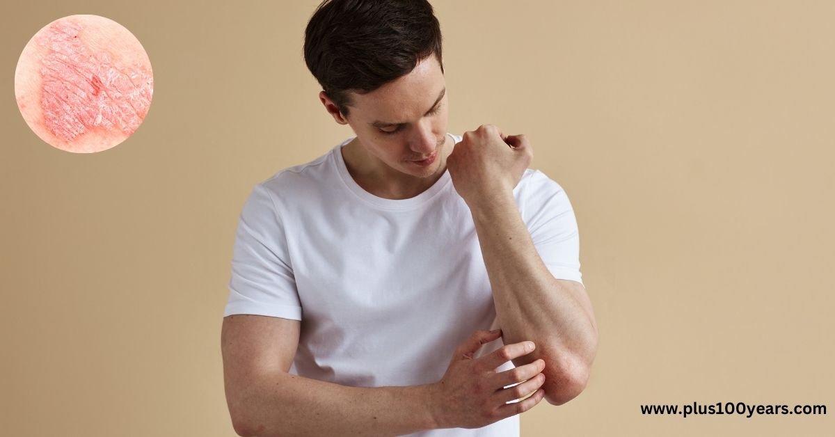 What is Psoriasis Know the perfect natural remedies for psoriasis