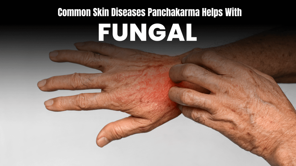 panchakarma treatment for fungal infections