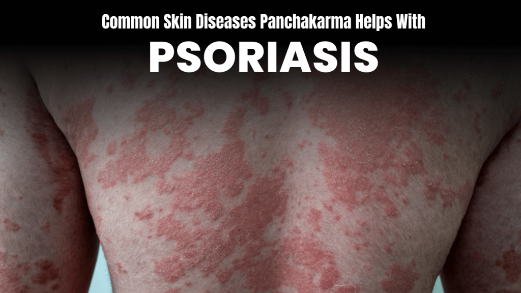 panchakarma treatment for psoriasis 